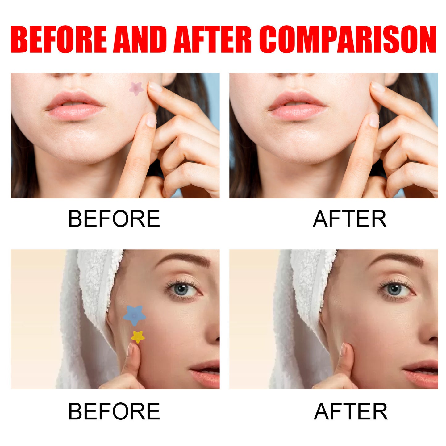 Adesivos Hidrocolóides para Acne – Tratamento Invisível de Espinhas e Manchas, 200 Peças