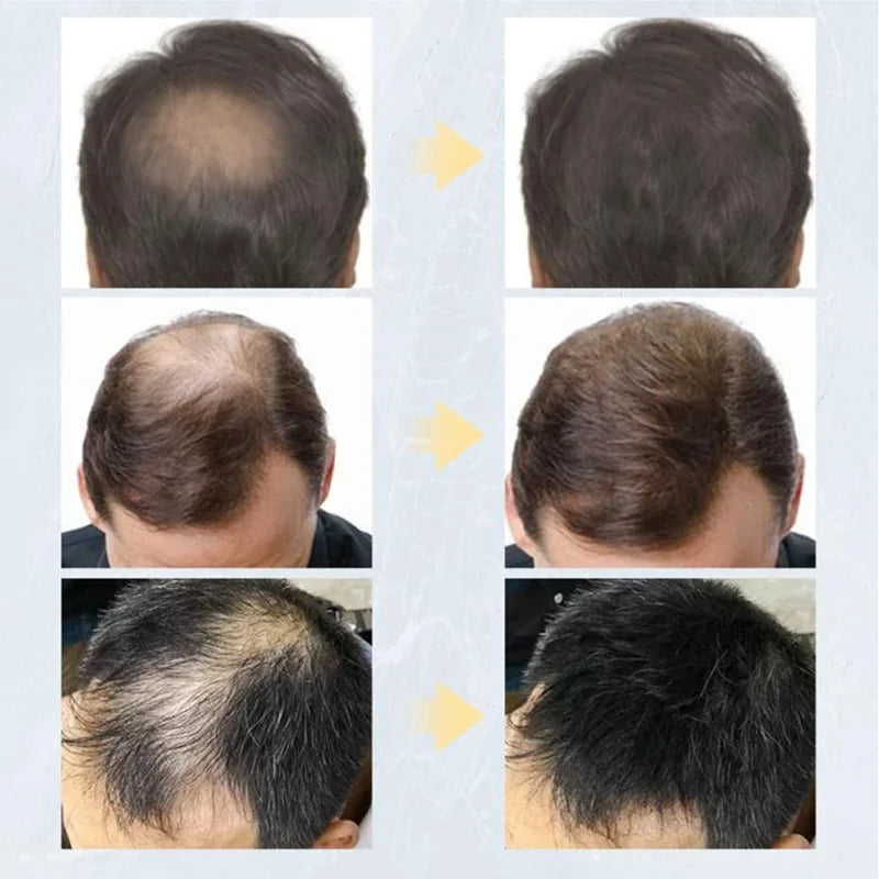 Fibra de Construção Capilar - 27,5g - Pó de Queratina Natural para Cabelo Fino e Calvo.Revitalize a aparência do seu cabelo com o Toppik Fibra de Construção Capilar. Este produto inovador utiliza fibras de quer