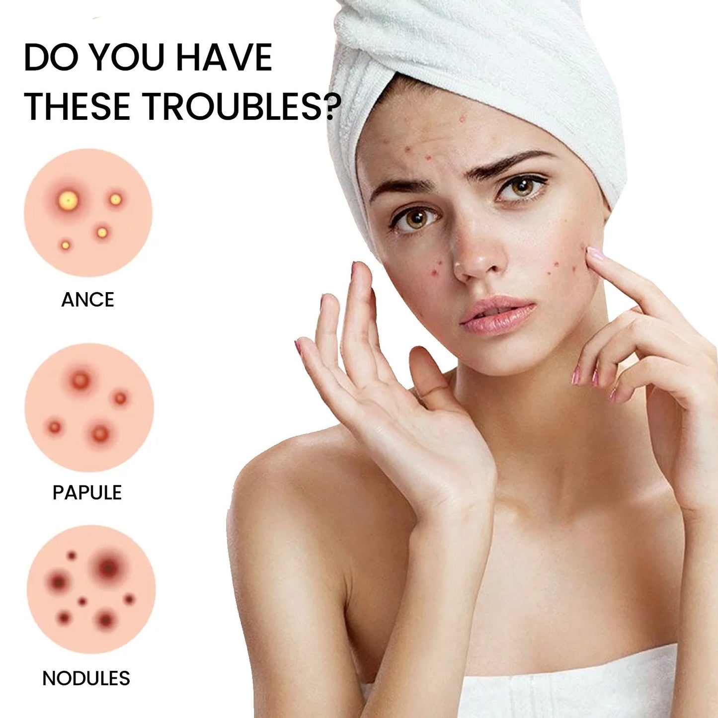 Adesivos Hidrocolóides para Acne – Tratamento Invisível de Espinhas e Manchas, 200 Peças